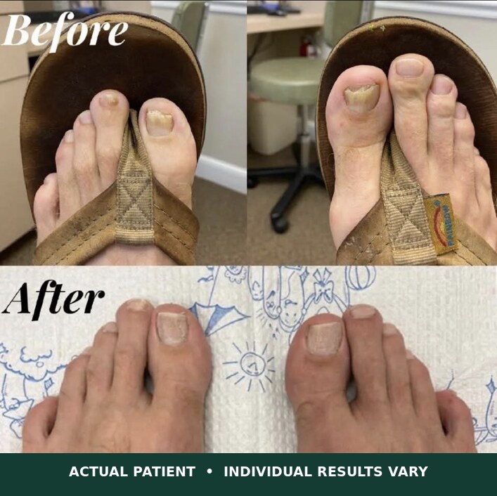 Actual patient before and after toenail treatment, showing clearer-looking nail growth